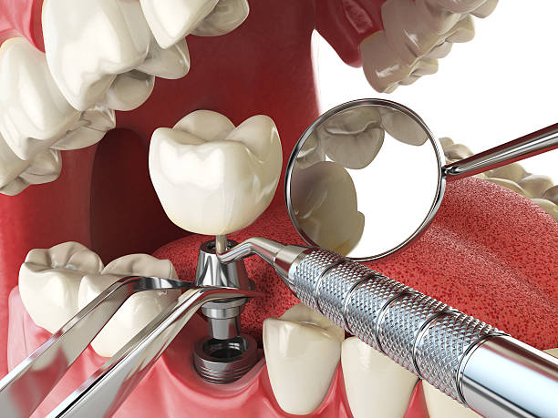 Best Urgent Tooth Repair  in Grand Point, LA